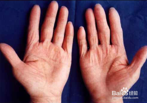 手癣预防事项包括哪些呢？