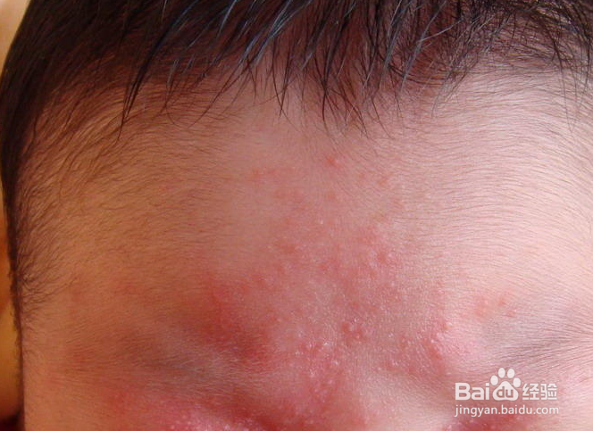 宝宝额头长奶癣怎么办