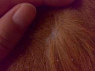 轻松按摩，摆脱头屑的困扰