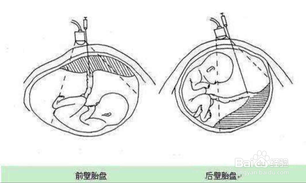 胎儿位于前壁和后壁有什么区别