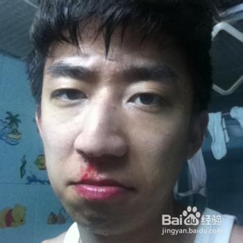 如何快速止住流出的鼻血