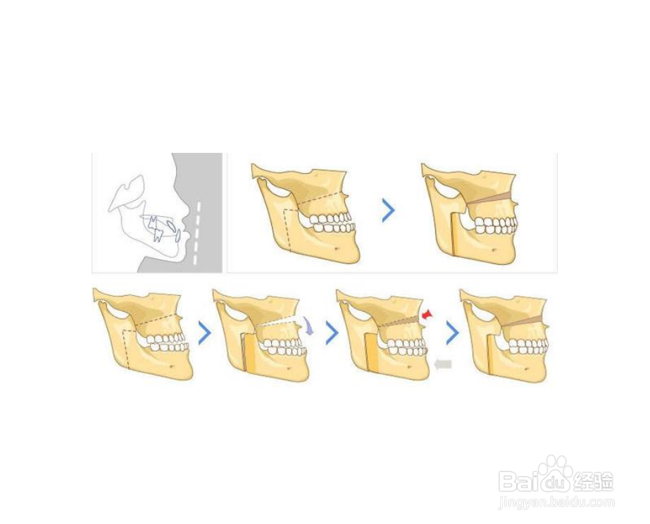 整完牙为什么要带保持器？