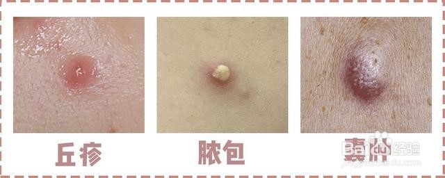 背部起痘怎么去除？