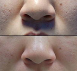 怎样收 缩脸部毛孔