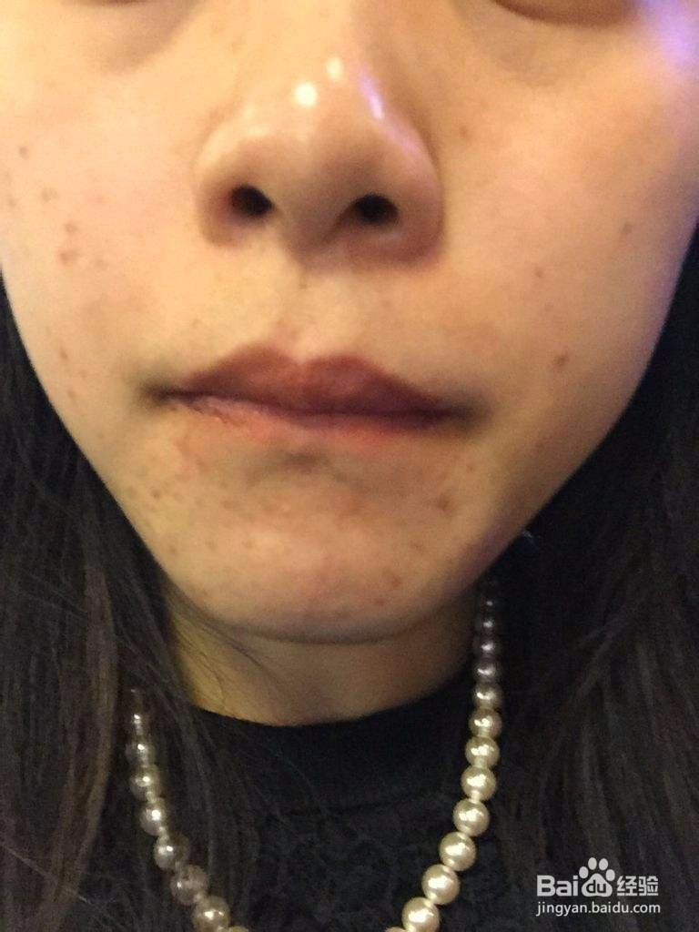 痘印多久可以代谢掉