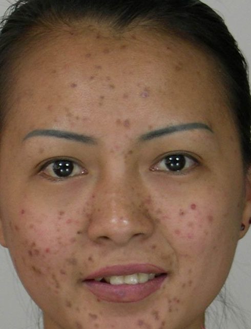 Photoshop CS2.0教你怎样祛痘和让图片亮