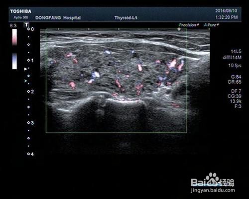桥本氏甲状腺炎如何调理?