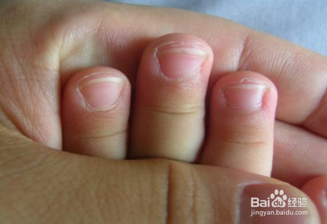 如何对新生宝宝的皮肤问题？