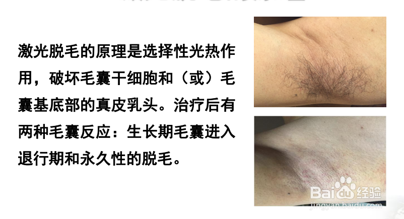 激光脱毛永久吗