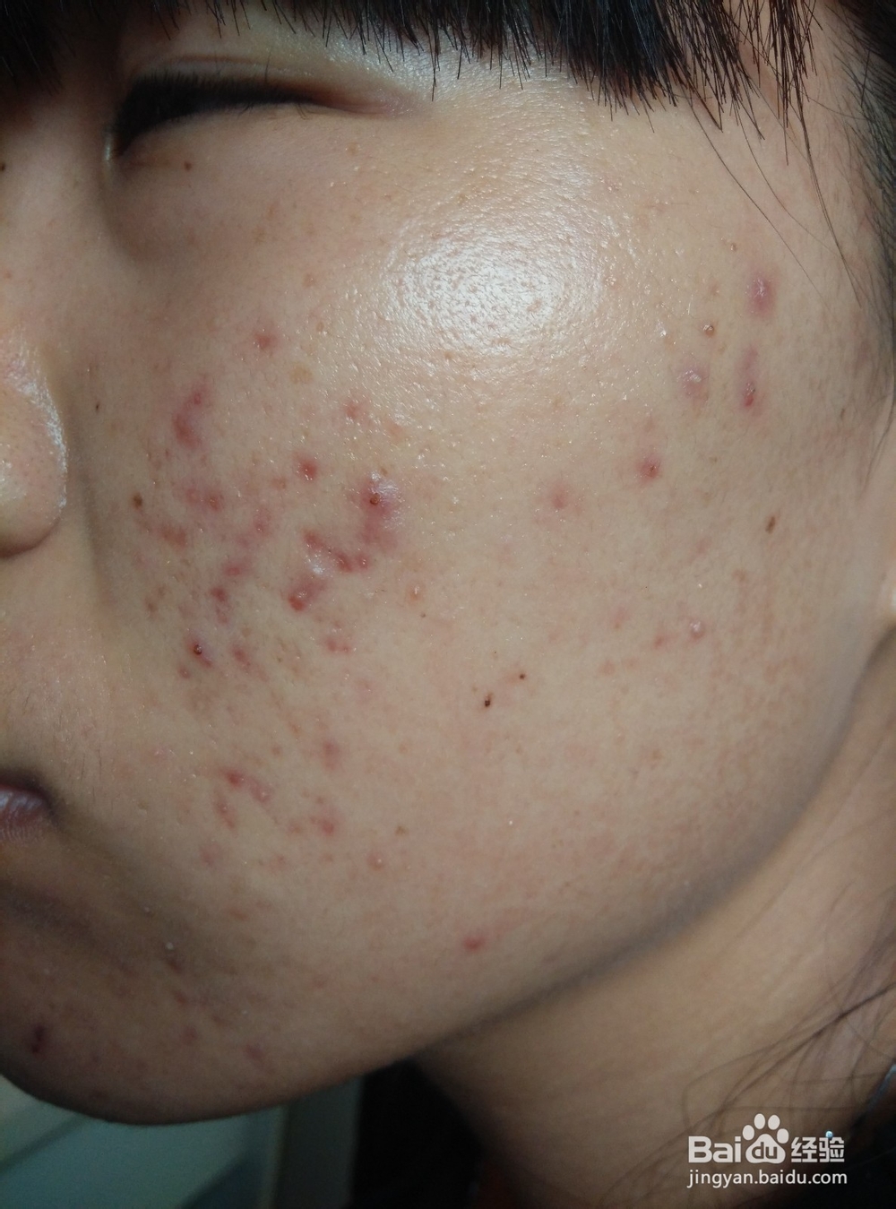 如果更好的祛痘