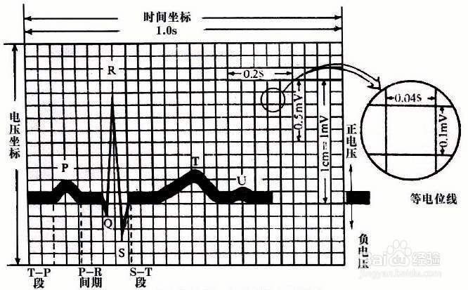 心电图各种波段解析