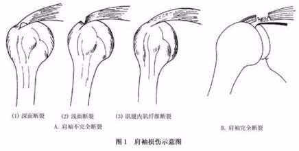 肩袖损伤的康复