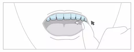南宁隐形矫治器正确的摘戴方法