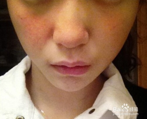 面部皮肤过敏怎么治