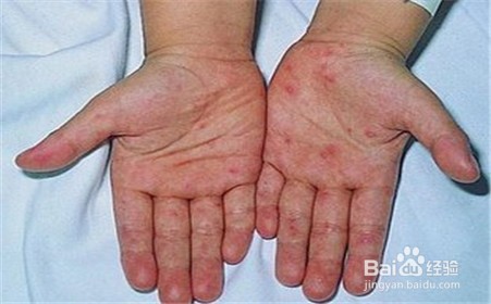 手指上有小水泡特别痒怎么办