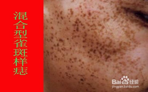 怎样调理男人脸上的斑/男性雀斑如何调理