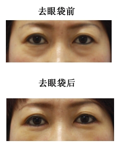 去眼袋前后对比图