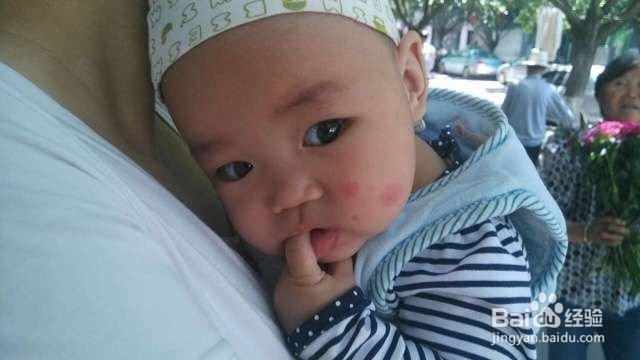 蚊子叮了如何止痒