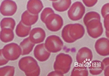 继发性血小板增多症发病机制