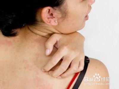 春节如何防止小孩发生皮肤病