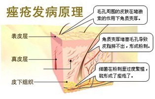 几个小细节帮忙祛痘
