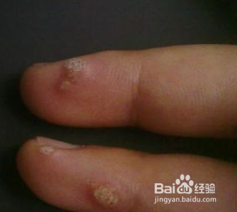 手上长瘊子怎么治最好