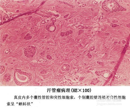 汗管瘤有哪几种类型哪种汗管瘤最好治