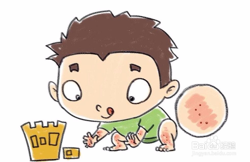 小儿荨麻疹该如何护理?