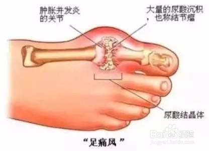 痛风治疗小知识