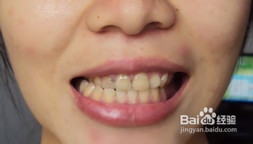 导致牙齿不齐的原因