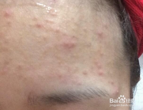 额头毛孔粗大怎么办