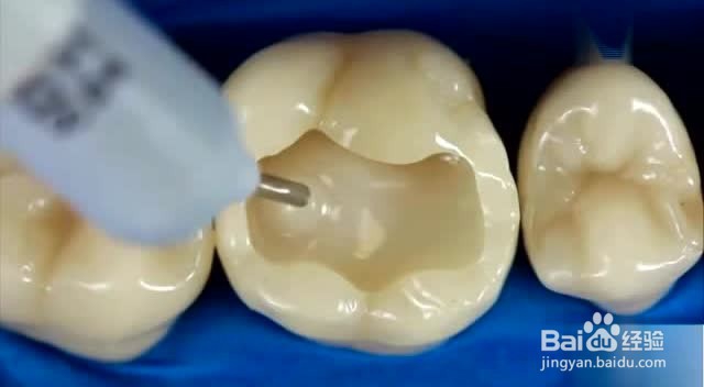 合肥补牙多少钱一颗