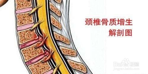 关于骨质增生，我们应该注意哪些问题？