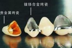 烤瓷牙和全瓷牙区别