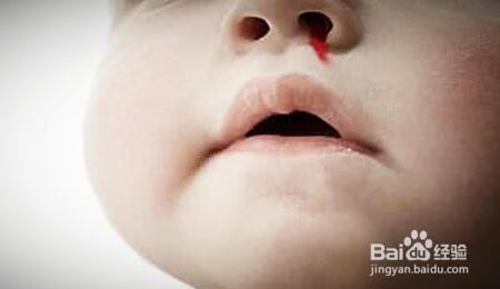 儿童经常流鼻血,这些小妙招教你快速处理鼻血