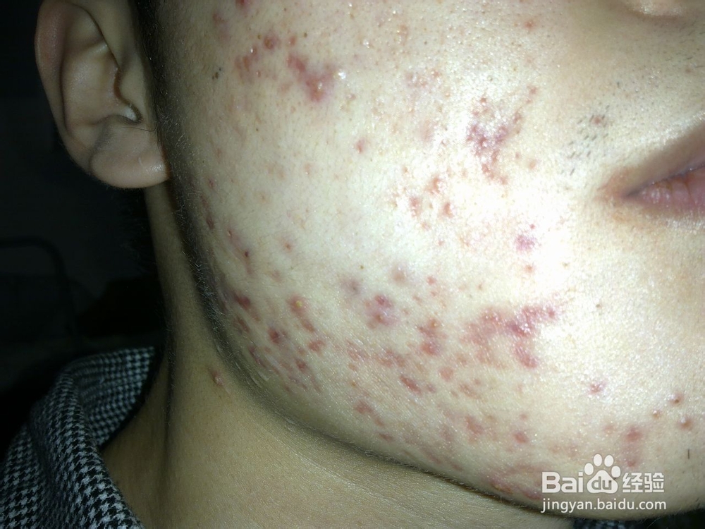 脸上长脓包豆豆怎么办