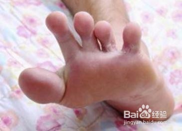 长期有脚气怎么办