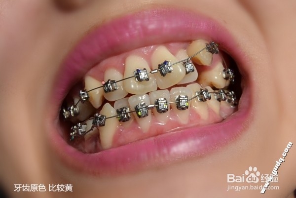 牙齿矫正：[2]带牙套的第二天的感受