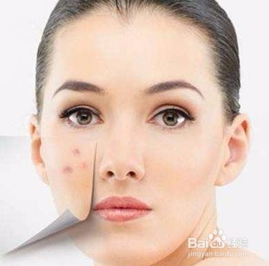 痘痘肌平时饮食要注意哪些宜和忌?