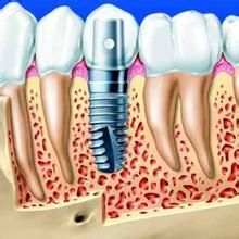 种植牙烤瓷牙的区别