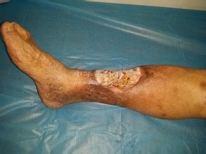 静脉曲张简介、预防、治疗