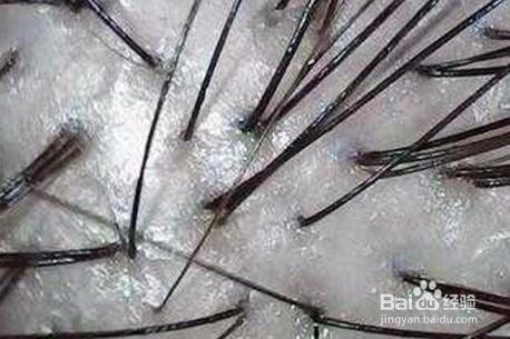 生发知识:脂溢性脱发治疗,关毛孔闭合了怎么办