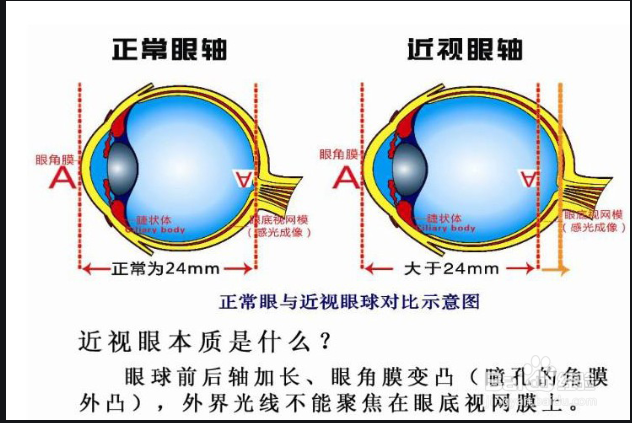 青少年如何预防近视眼