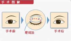 做埋线双眼皮多少钱
