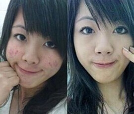 如何消灭上火痘和胜生理痘