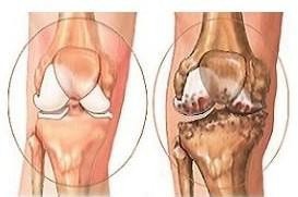 膝盖疼是怎么回事分情况护理膝关节