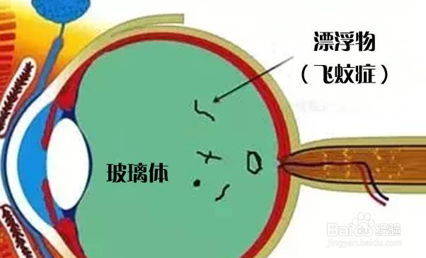 飞蚊症产生的原因及缓解方法
