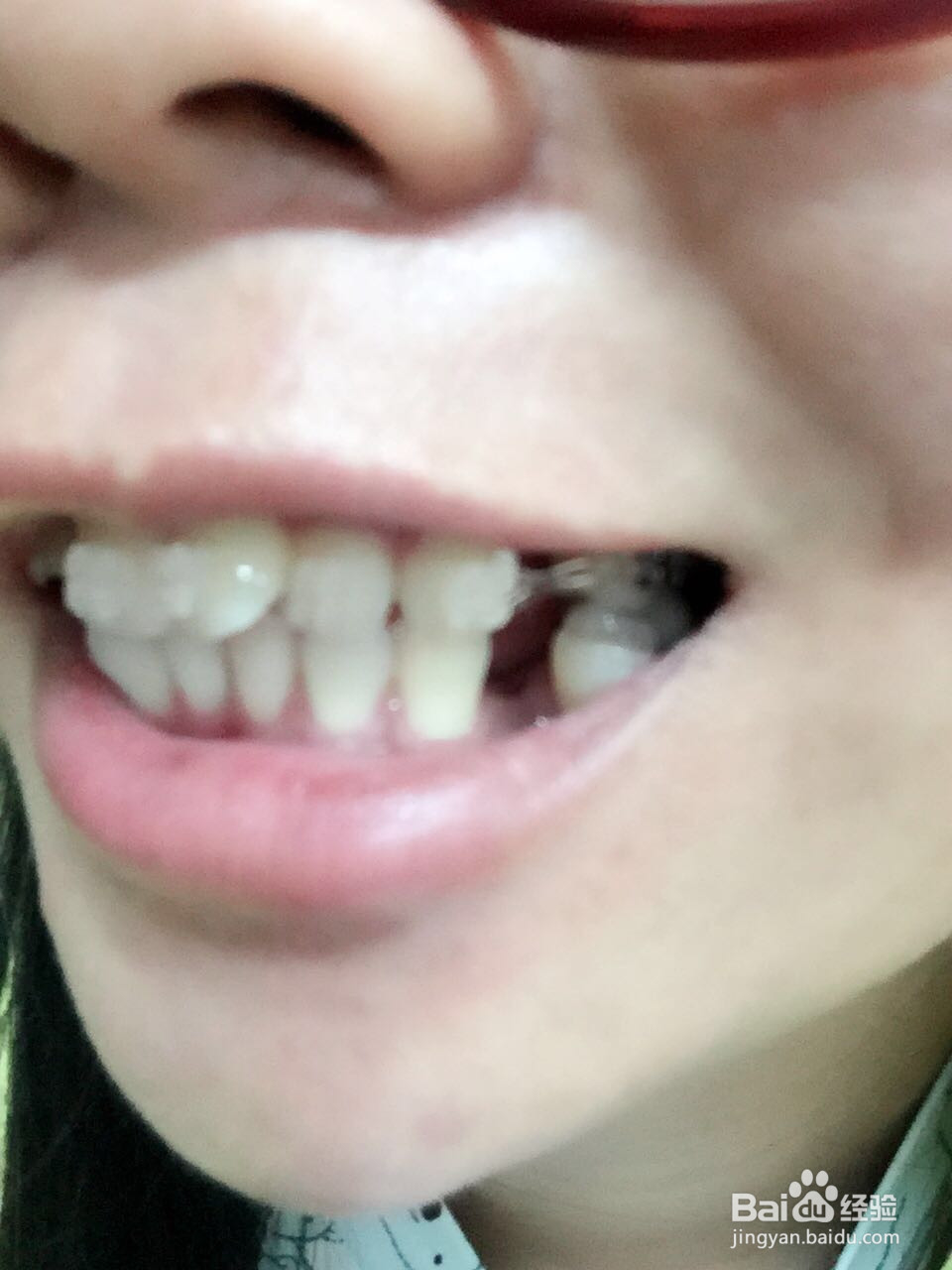 牙套妹正式戴牙套的懵懂