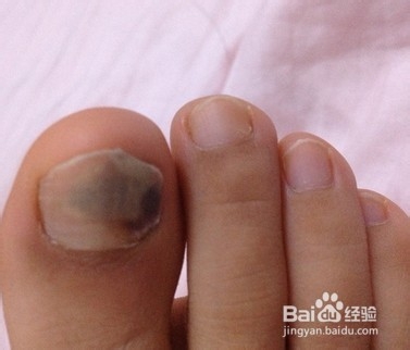 得了灰指甲的危害