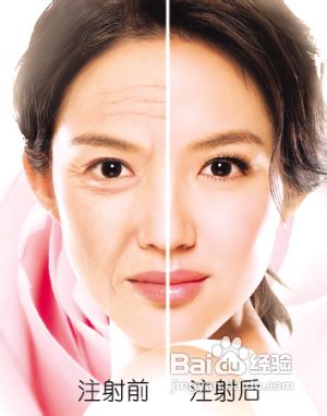 注射除皱注意事项